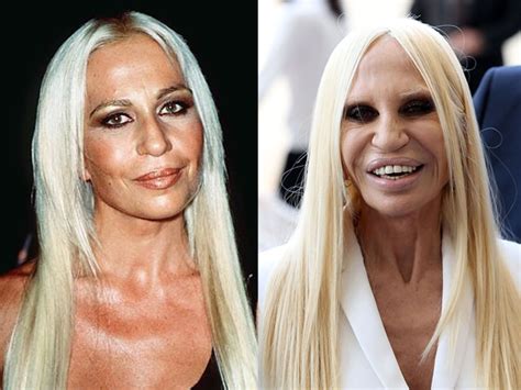 donatella versace cirugias plasticas